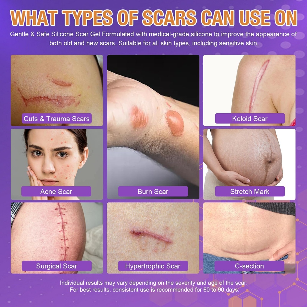 advanced-scar-gel-silicone-scar-gel-for--3.jpg