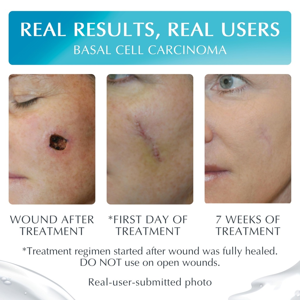 advanced-high-potency-silicone-scar-gel--3.jpg