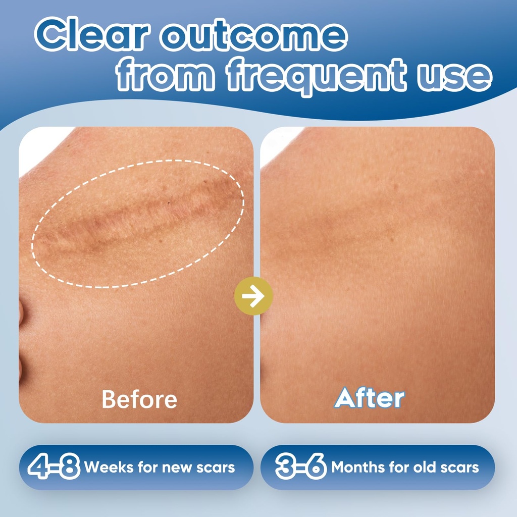 advanced-silicone-scar-gel-for-face-body-6.jpg