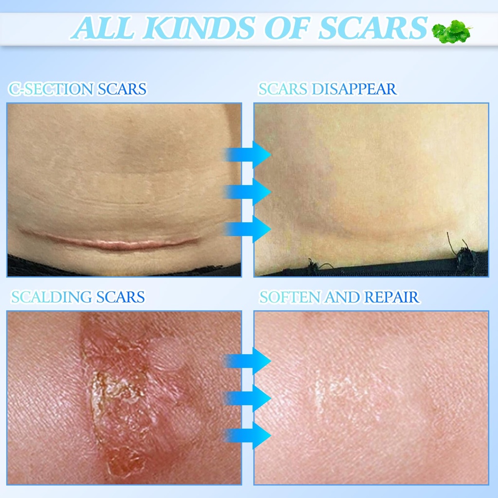 2pcs-scar-cream-for-men-and-women-face-b-6.jpg