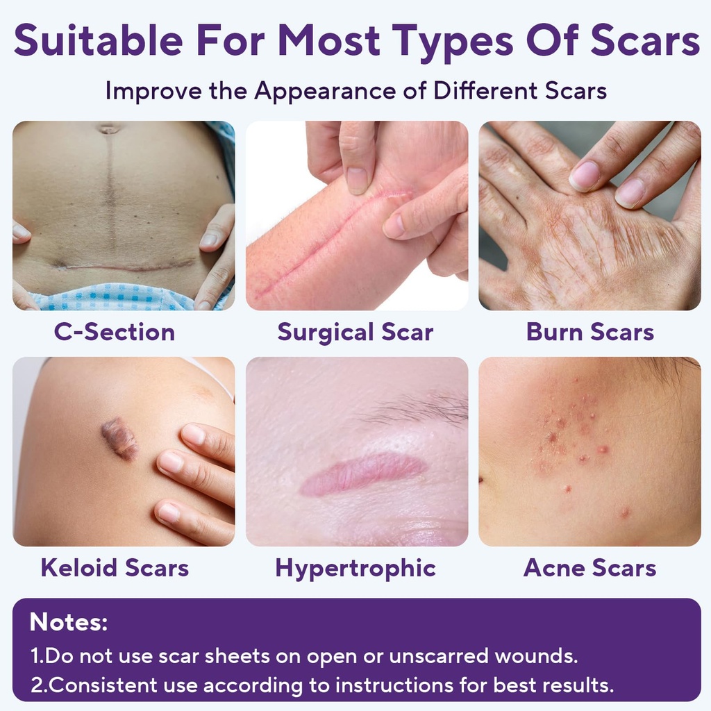 silicone-scar-sheets-silicone-scar-tape--2.jpg