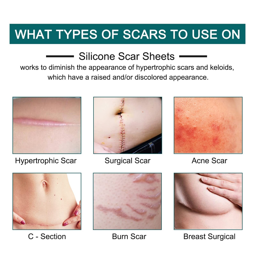 silicone-scar-sheets-1-6-x-120-roll-3m-s-2.jpg