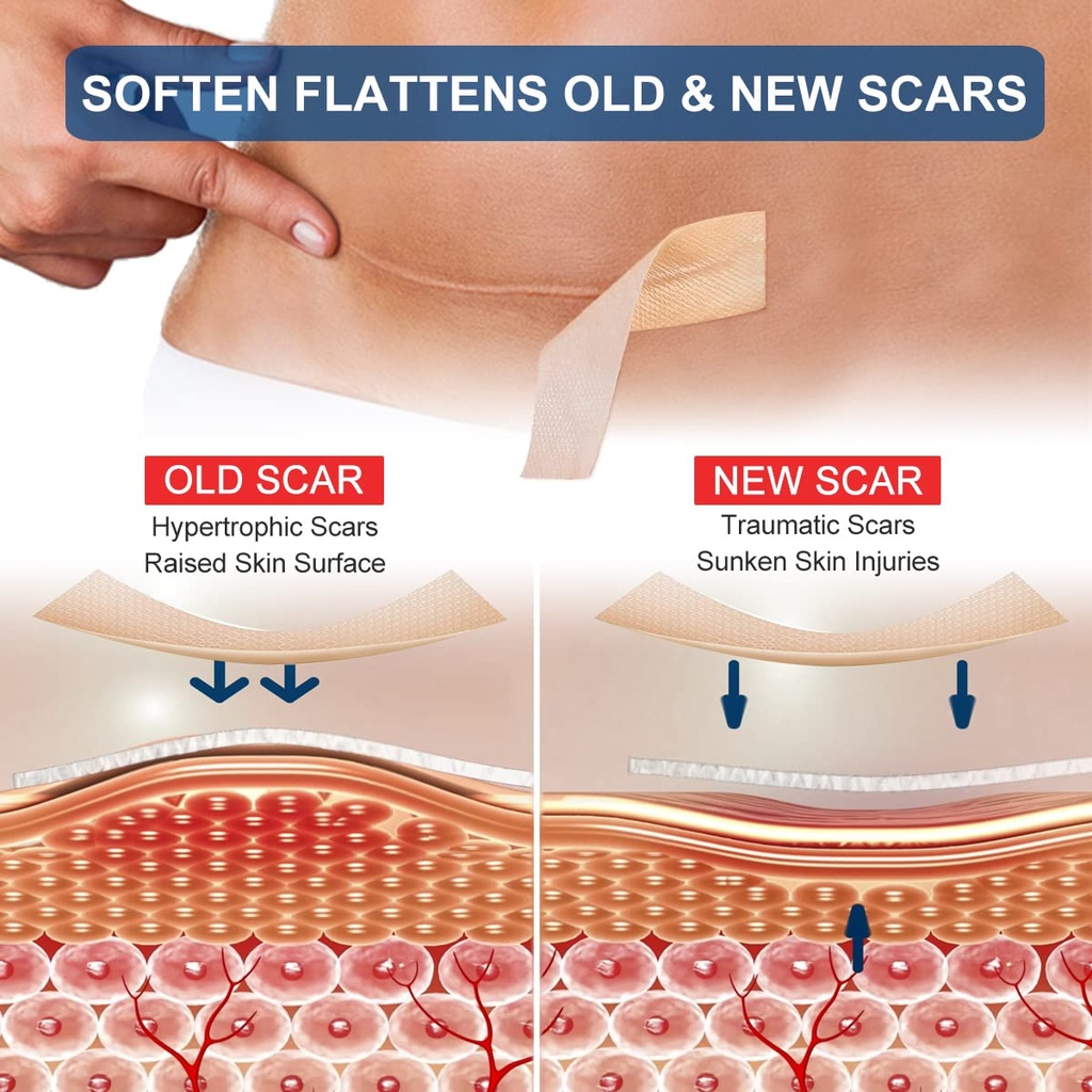 silicone-scar-sheets-1-6-x-120-roll-3m-s-3.jpg