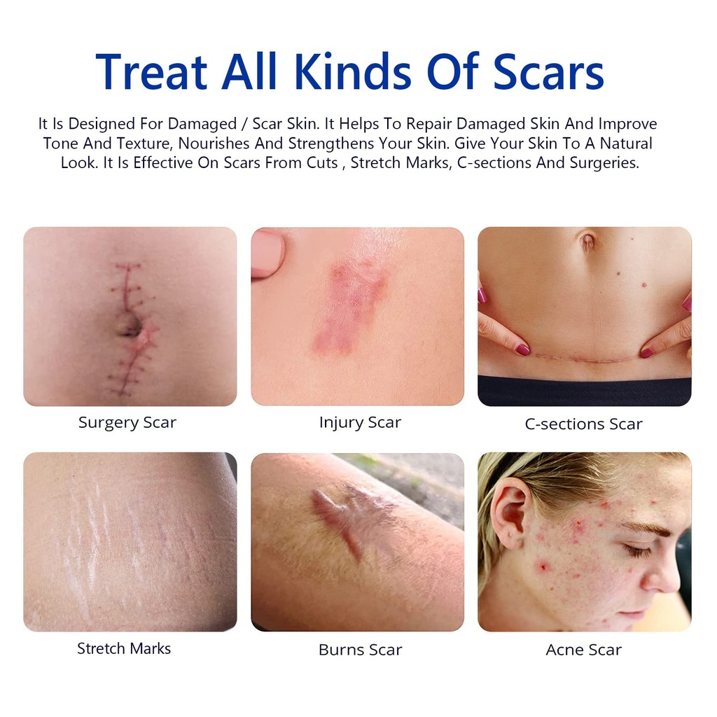 scar-cream-scar-removal-cream-advanced-s-3.jpg