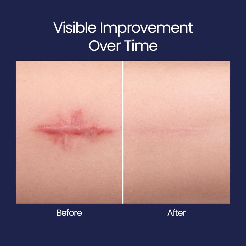 silicone-scar-patches-strips-18-pre-cut--6.jpg