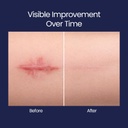 silicone-scar-patches-strips-18-pre-cut--6.jpg