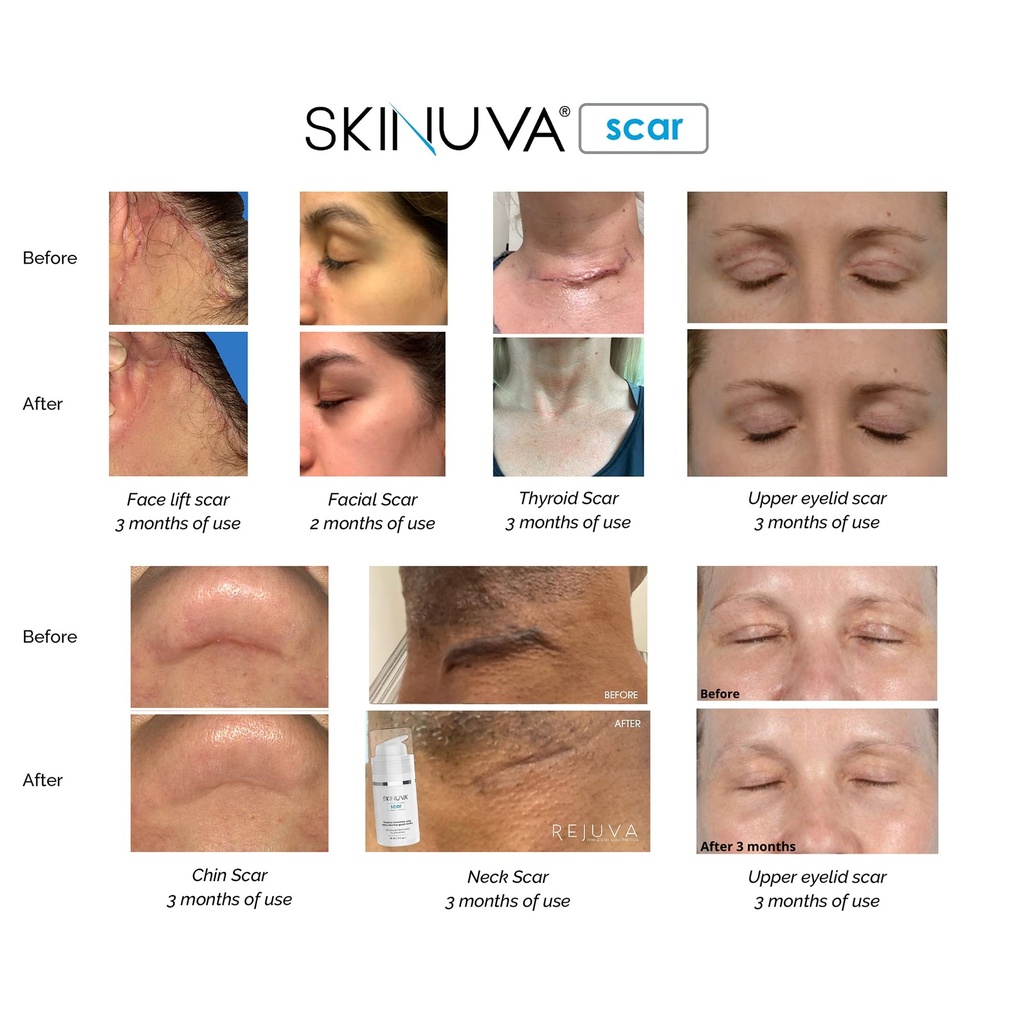 skinuva-scar-cream-for-face-body-old-new-6.jpg