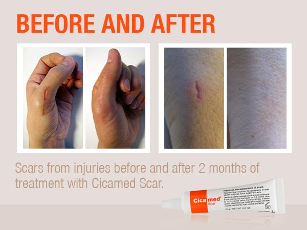 silicone-scar-gel-works-with-tape-advanc-5.jpg