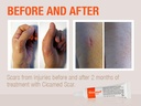 silicone-scar-gel-works-with-tape-advanc-5.jpg