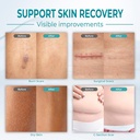 aloe-vera-medical-grade-silicone-scar-sh-3.jpg