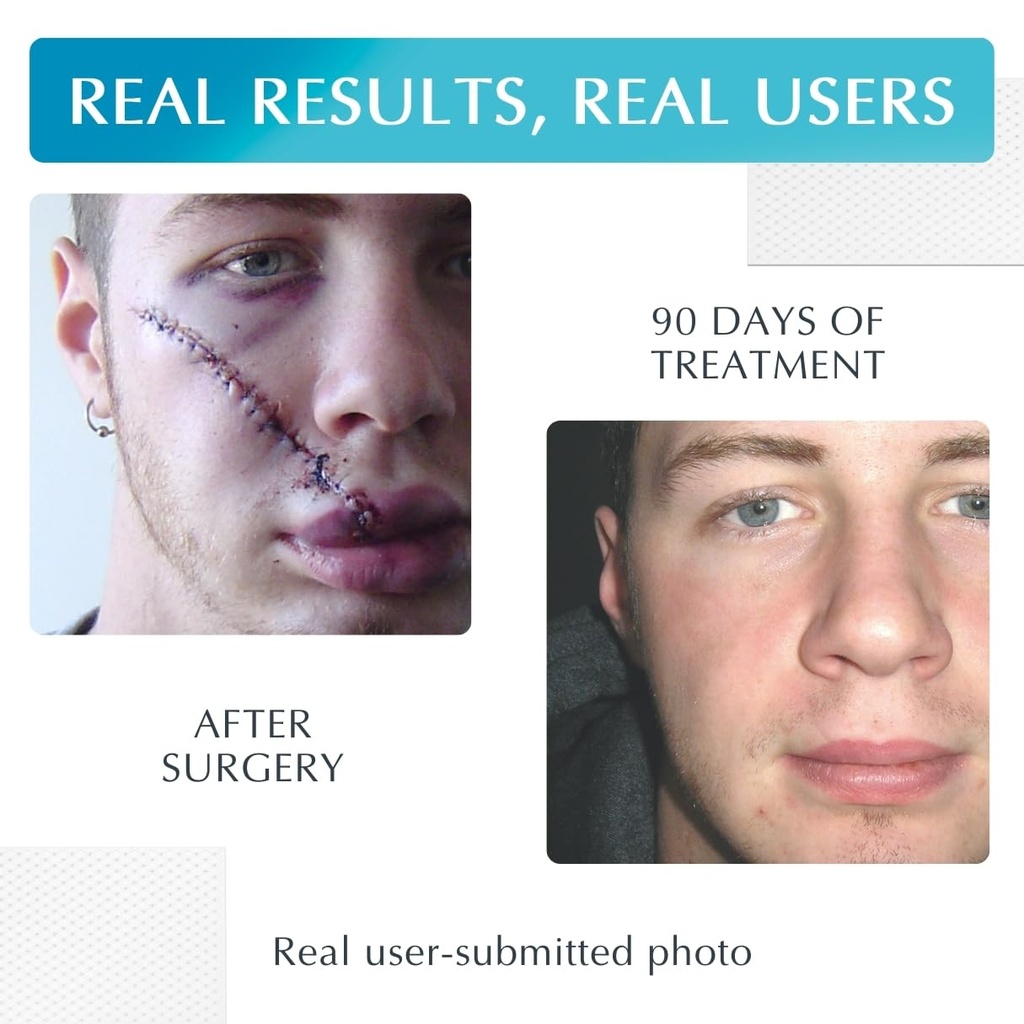 mynewgel-advanced-silicone-scar-treatmen-3.jpg