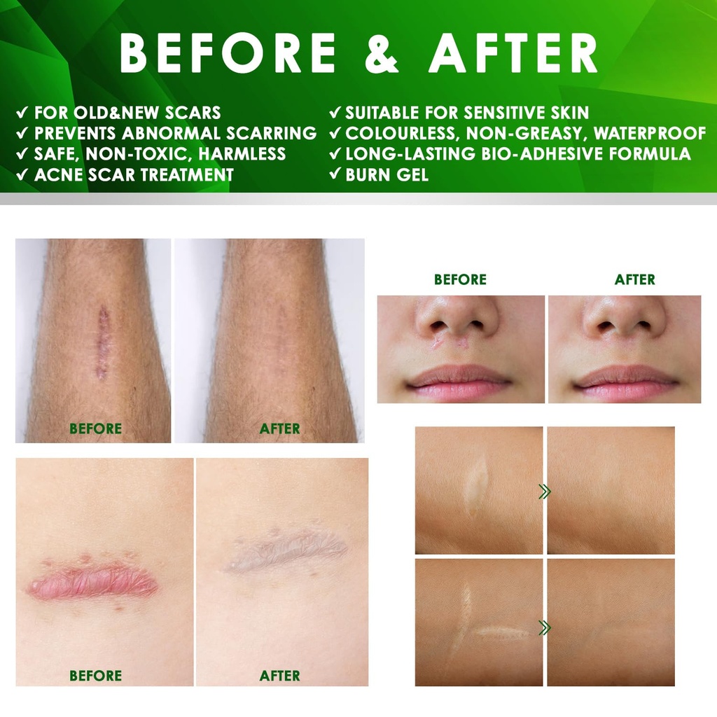 tobcharm-advanced-keloid-scar-care-gel-s-6.jpg