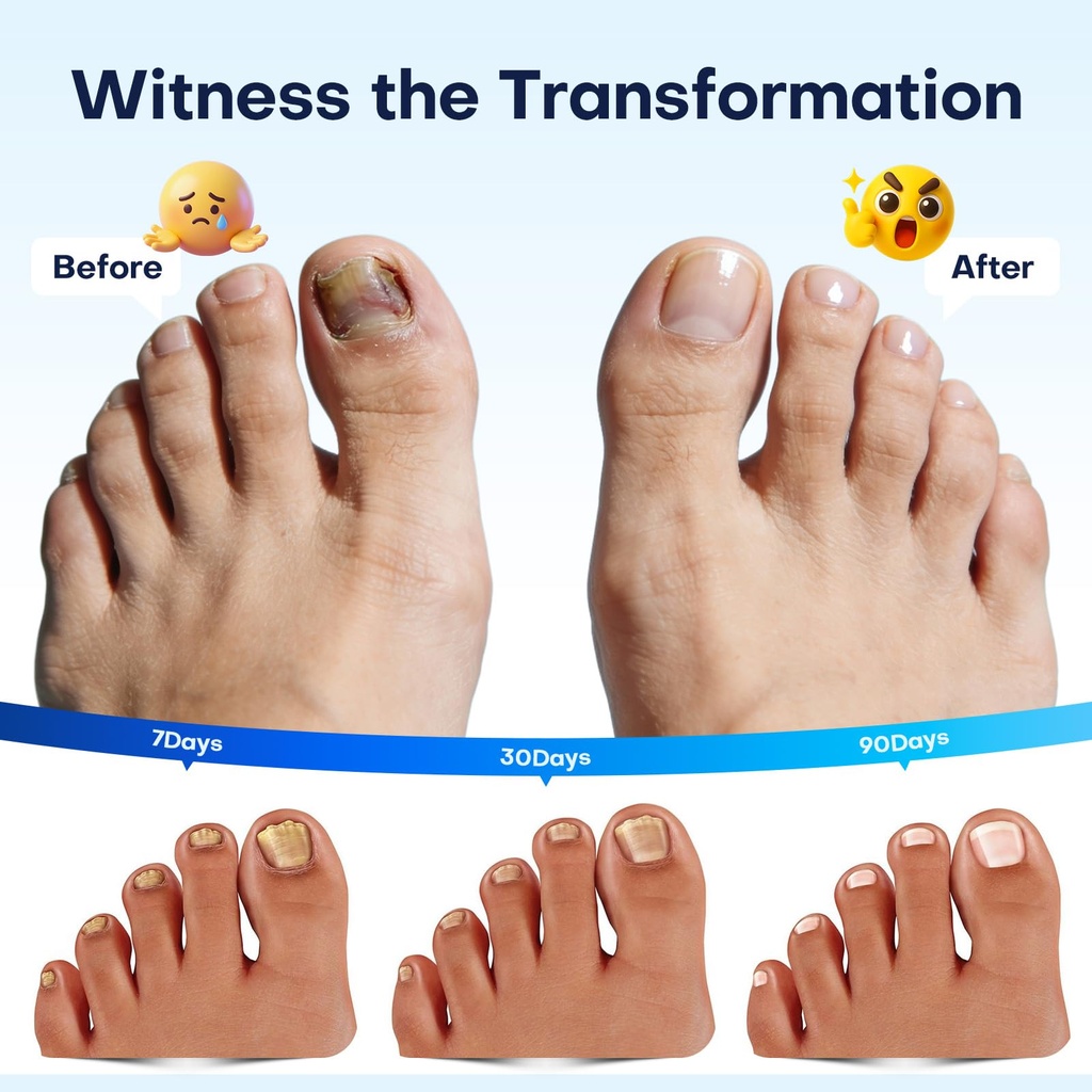 villsure-toenail-fungus-pen-toenail-fung-4.jpg
