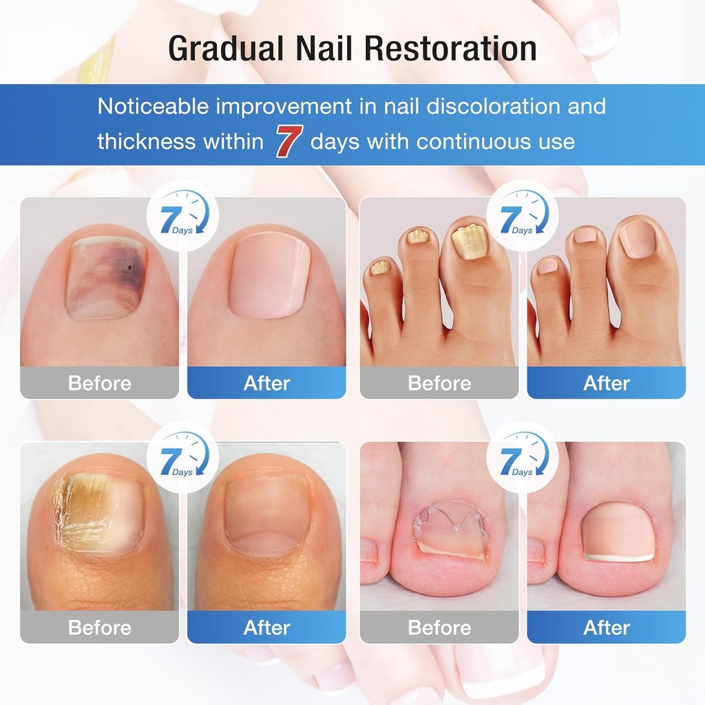toenail-fungus-treatment-extra-strength--5.jpg