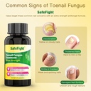 toenail-fungus-treatment-with-25-undecyl-3.jpg