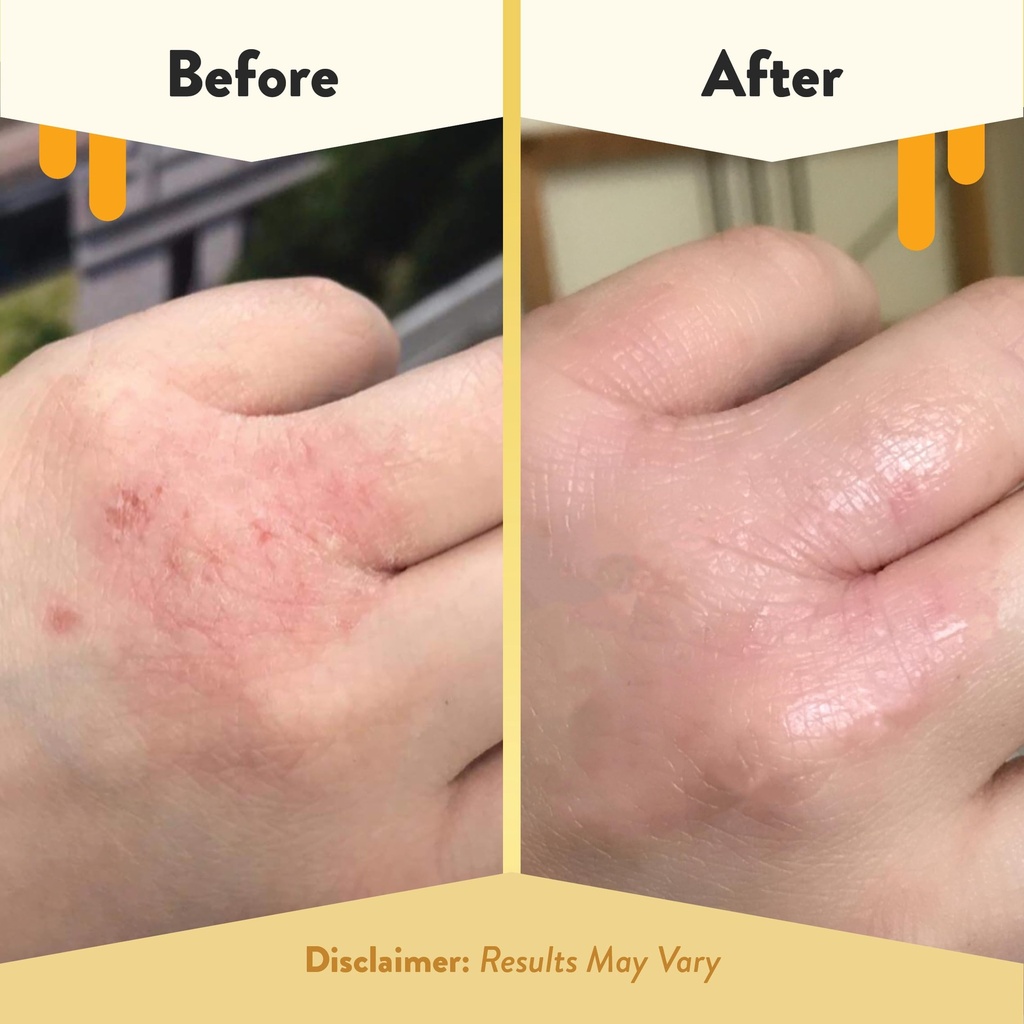 eczema-honey-original-skin-soothing-crea-4.jpg