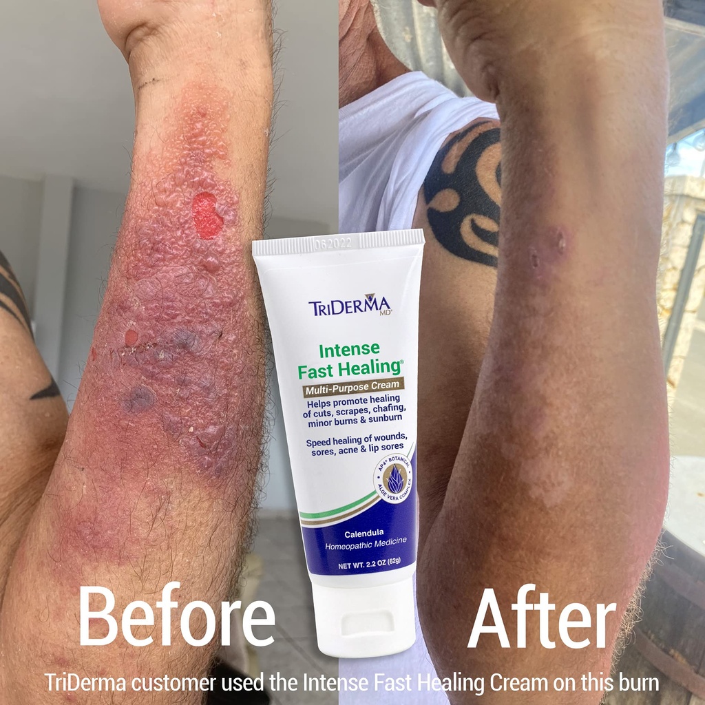 triderma-intense-fast-skin-healing-cream-2.jpg