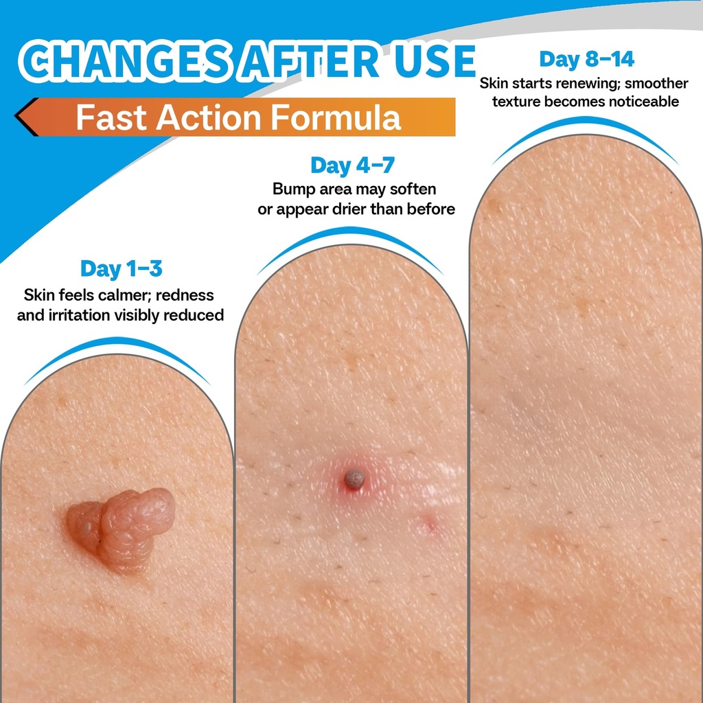 molluscum-support-treatment-molluscum-su-3.jpg