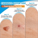 molluscum-support-treatment-molluscum-su-3.jpg