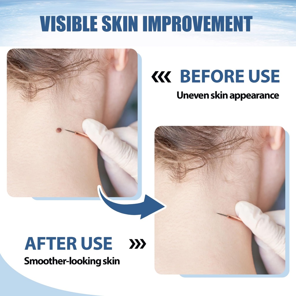 molluscum-support-treatment-molluscum-su-3.jpg