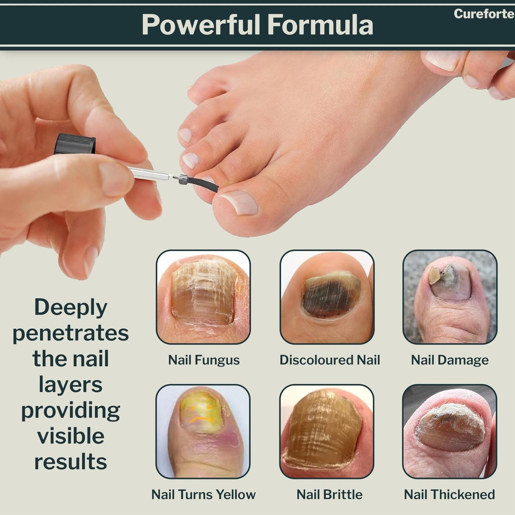 anti-fungal-foot-finger-nails-fungus-tre-3.jpg