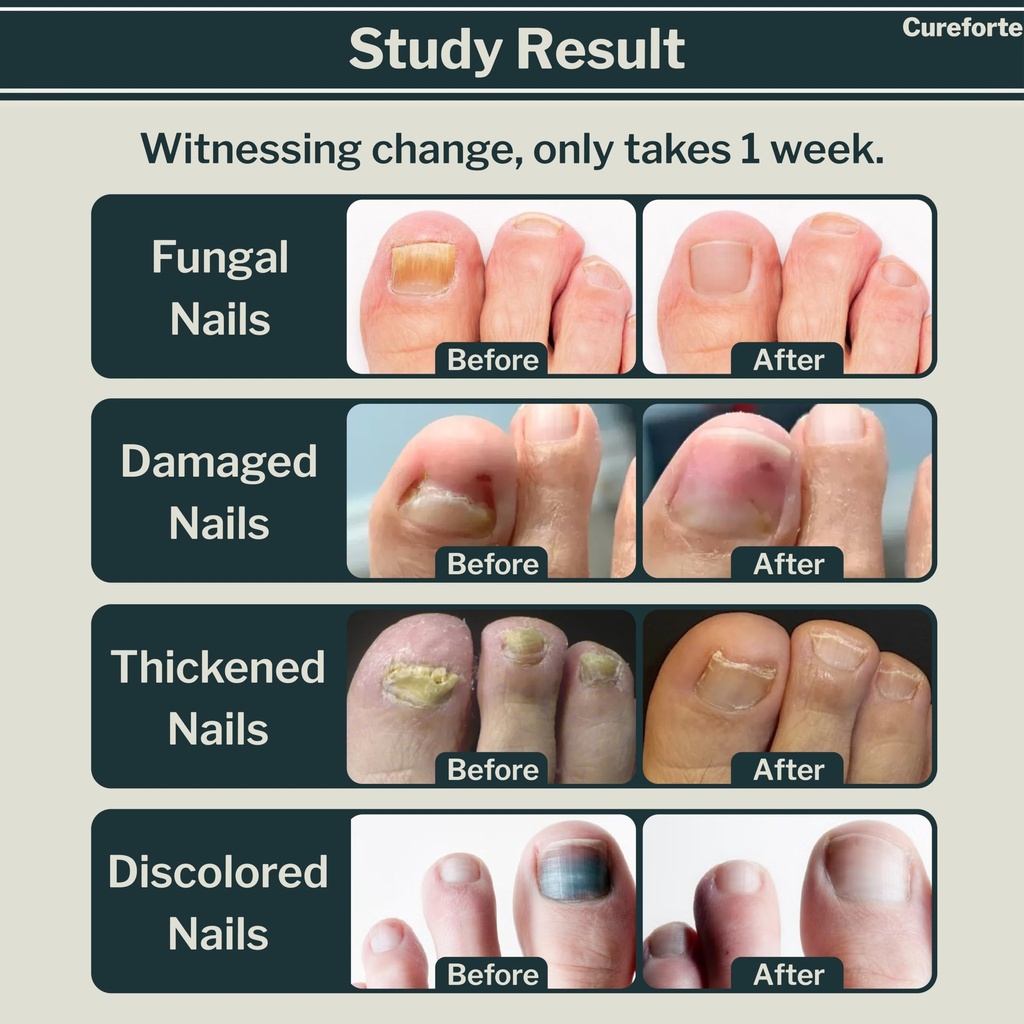 anti-fungal-foot-finger-nails-fungus-tre-2.jpg