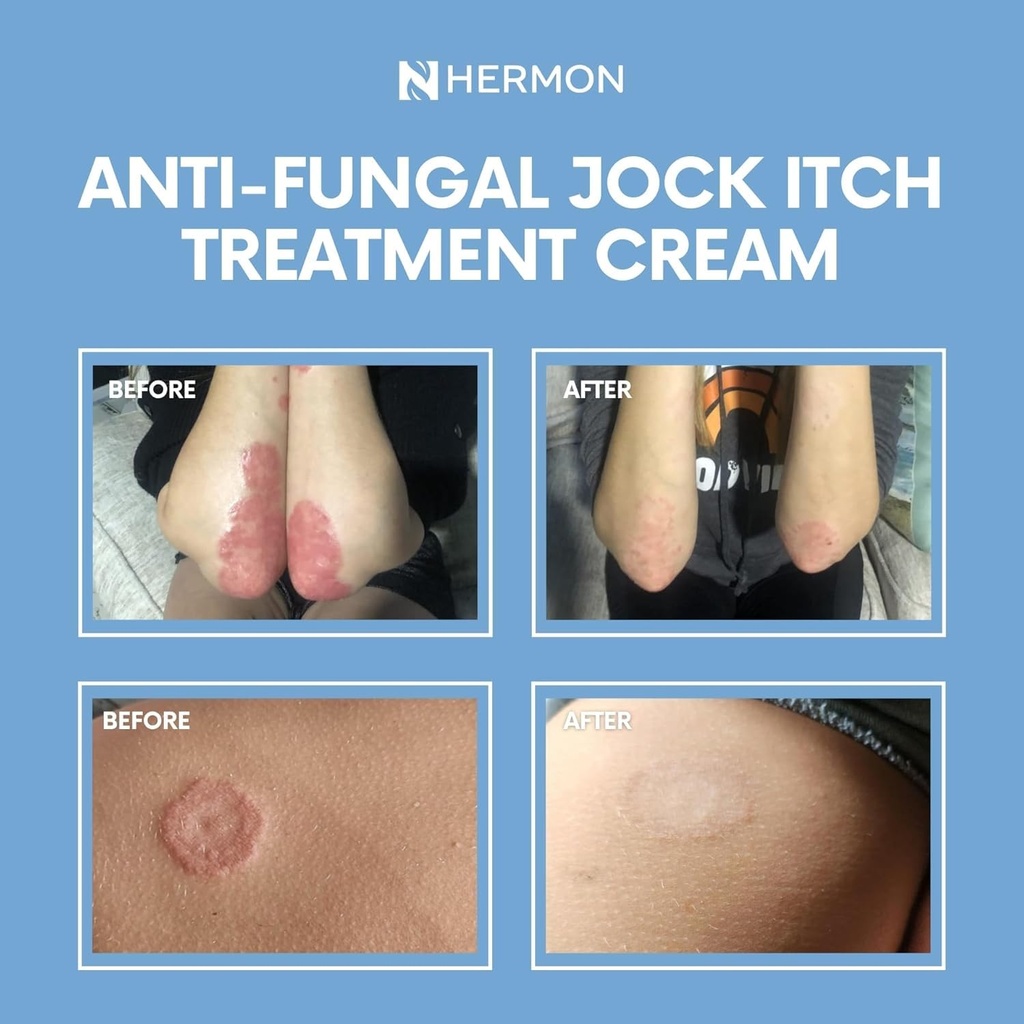 hermon-jock-itch-antifungal-cream-ringwo-6.jpg