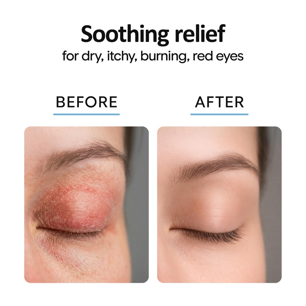 eyelid-cleanser-spray-8oz-blepharitis-tr-3.jpg