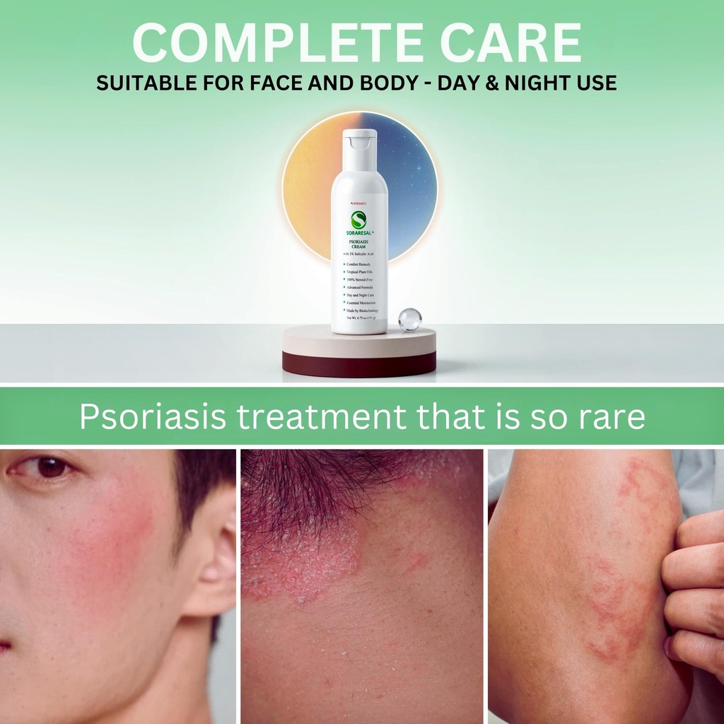 soraresal-psoriasis-cream-comfort-remedy-6.jpg