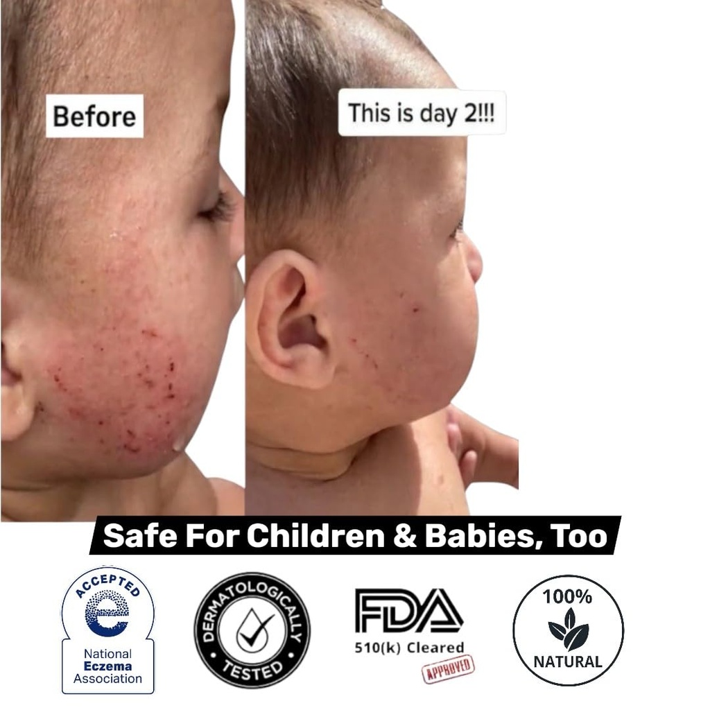 loma-lux-new-eczemol-otc-spray-natural-n-5.jpg