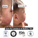 loma-lux-new-eczemol-otc-spray-natural-n-5.jpg