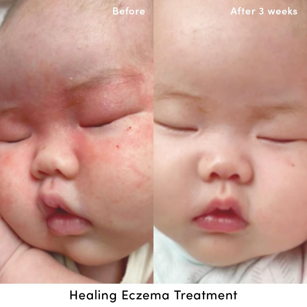 evereden-healing-eczema-treatment-1-7-fl-5.jpg