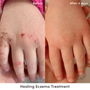 evereden-healing-eczema-treatment-1-7-fl-2.jpg