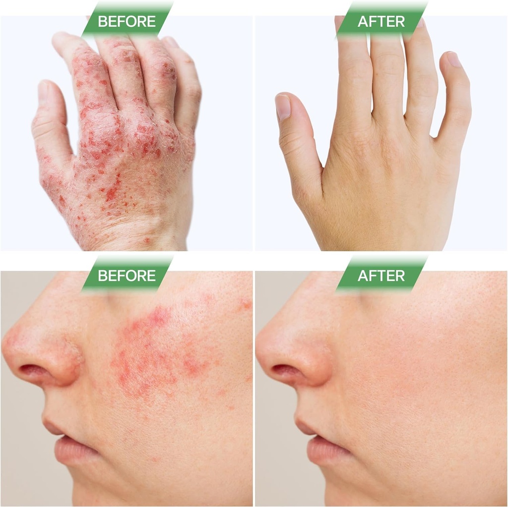 sugar-free-eczema-treatment-gummies-usa--5.jpg