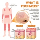 lovilds-psoriaheal-bee-venom-psoriasis-c-3.jpg