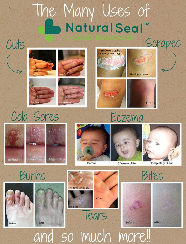 kericure-s-natural-seal-spray-on-bandage-5.jpg