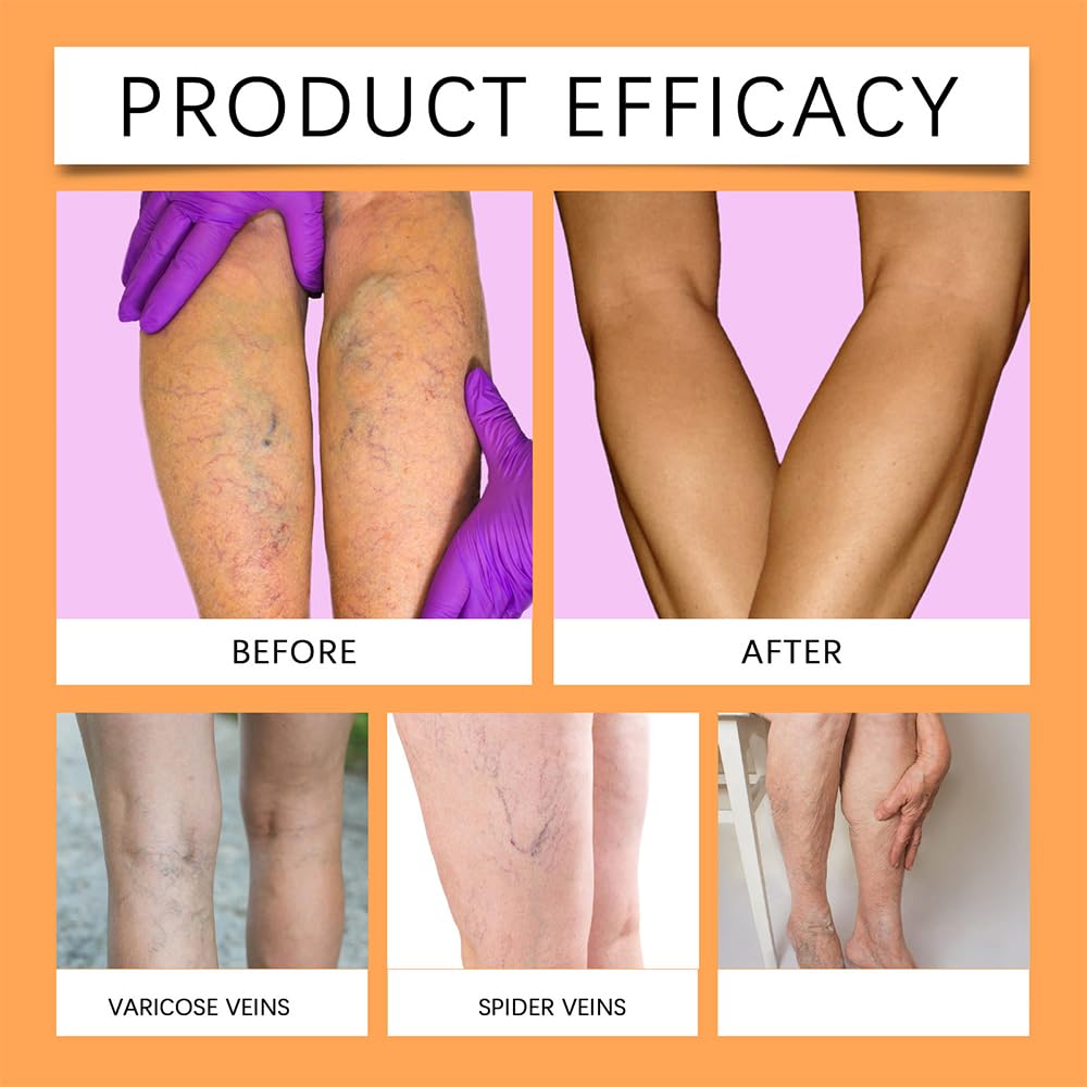 48-pcs-varicose-veins-treatment-for-legs-2.jpg