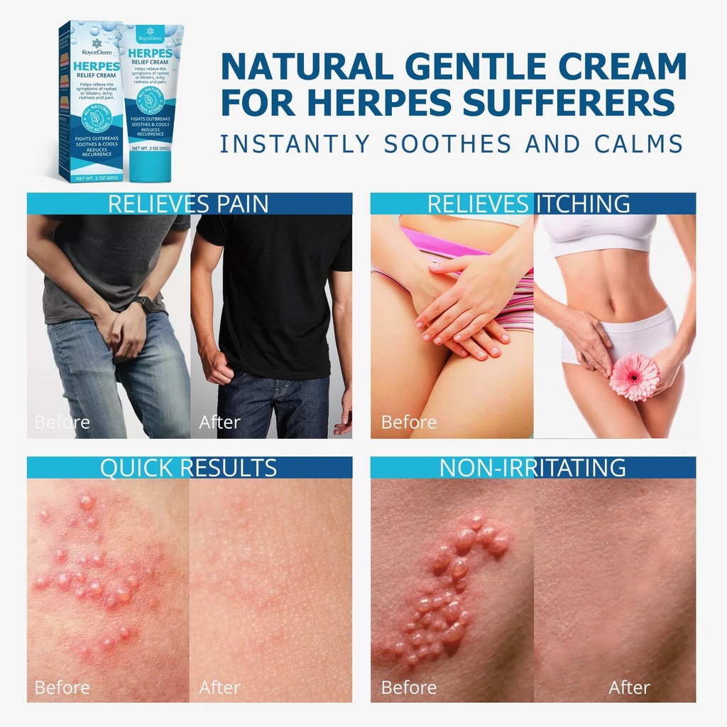 roycederm-herpes-cream-soothes-itching-r-4.jpg
