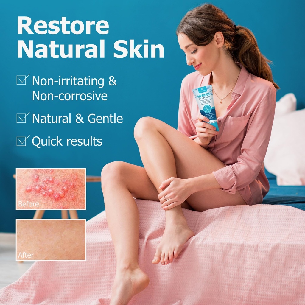 roycederm-herpes-cream-soothes-itching-r-2.jpg
