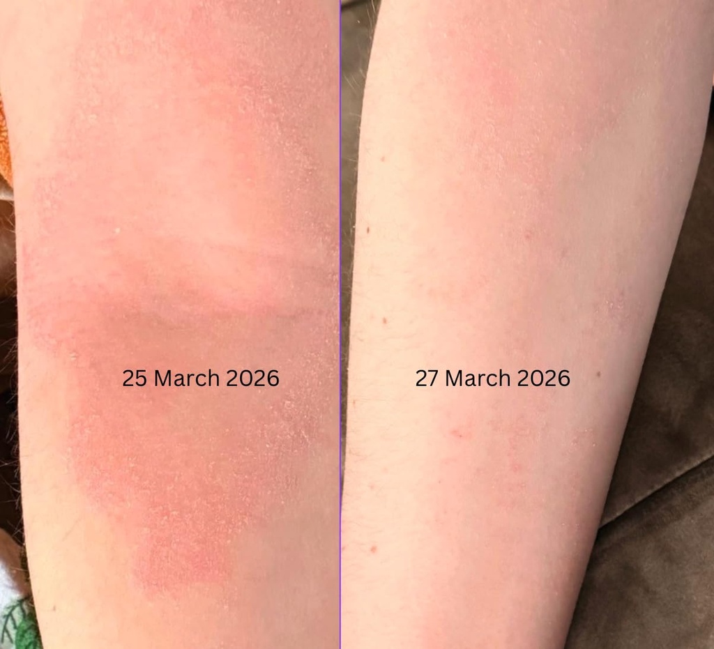 porphose-eczema-relief-spray-for-kids-an-3.jpg