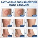 antifungal-ringworm-treatment-cream-mico-4.jpg