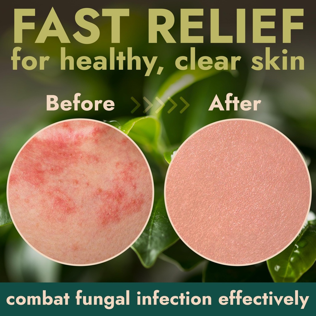 ringworm-cream-ringworm-treatment-for-hu-5.jpg
