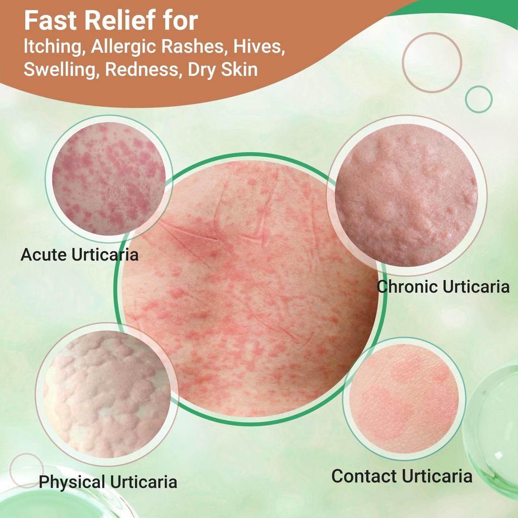 urticaria-cream-for-hives-relief-fast-ac-2.jpg