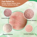 urticaria-cream-for-hives-relief-fast-ac-2.jpg