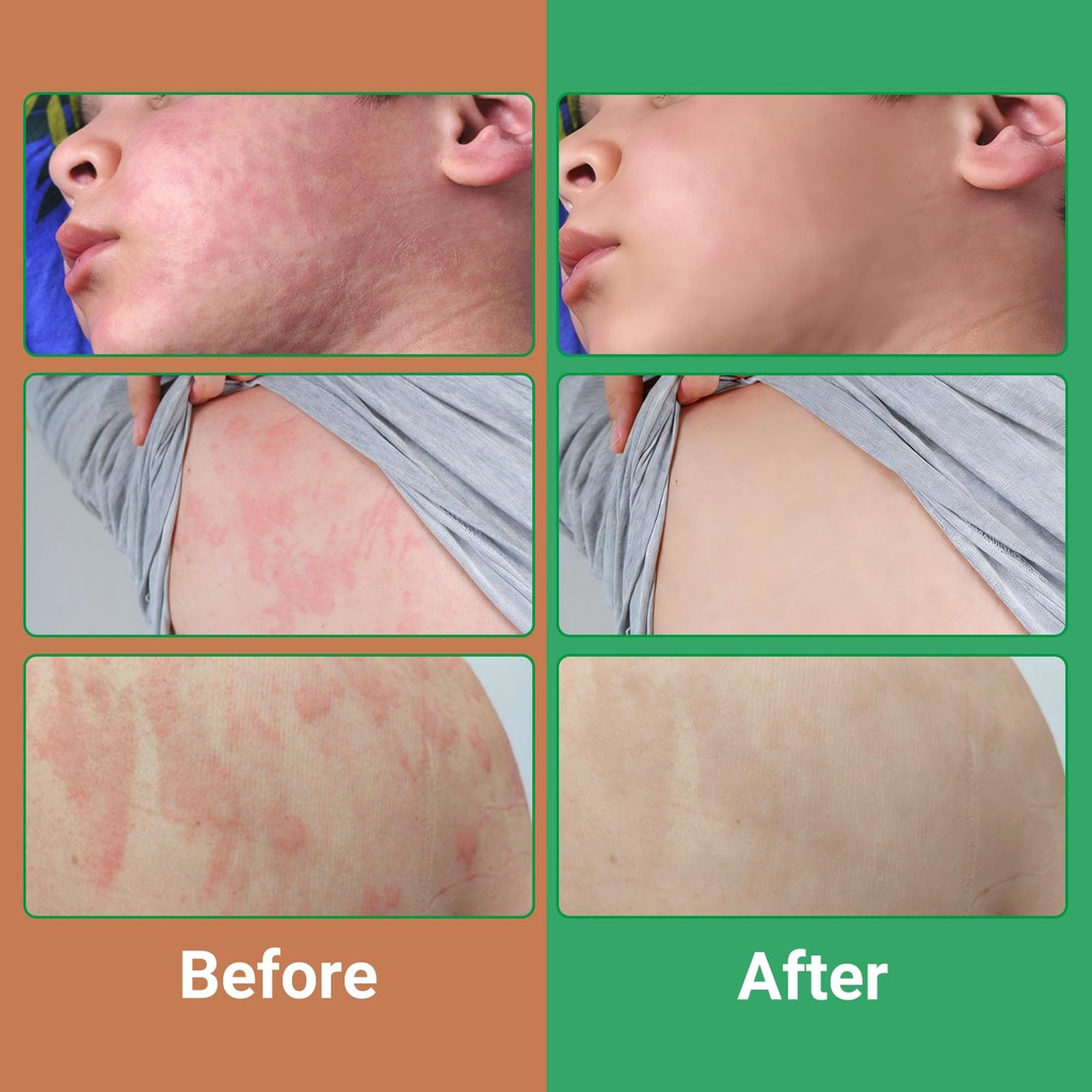 urticaria-cream-for-hives-relief-fast-ac-4.jpg