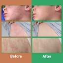 urticaria-cream-for-hives-relief-fast-ac-4.jpg