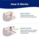 zquiet-anti-snoring-mouthpiece-comfort-s-2.jpg