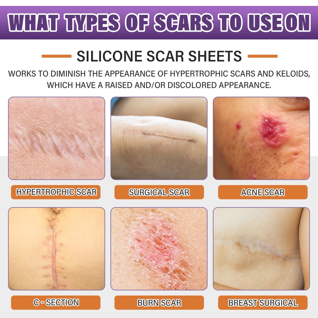 silicone-scar-sheets-medical-grade-silic-2.jpg