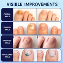 meoly-toenail-fungus-treatment-extra-str-5.jpg