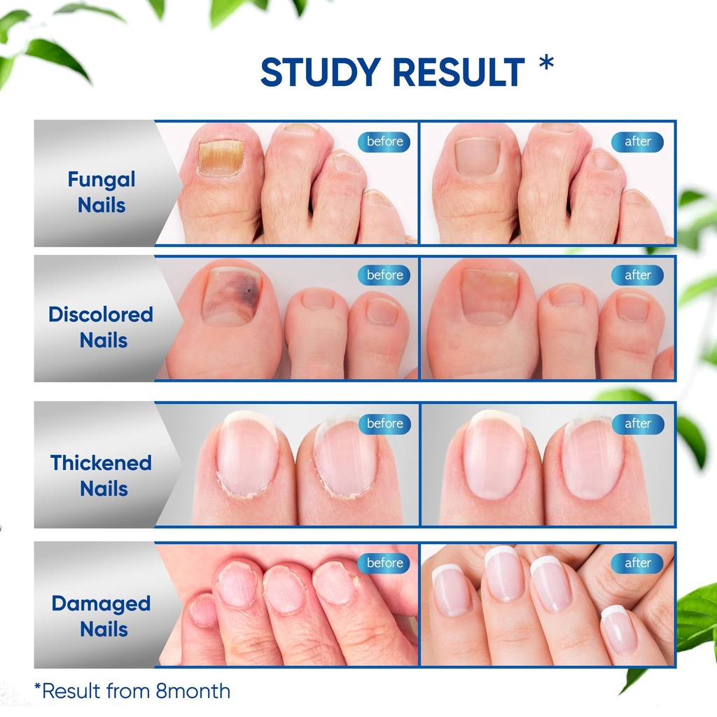 maximum-strength-toenail-fungus-treatmen-4.jpg